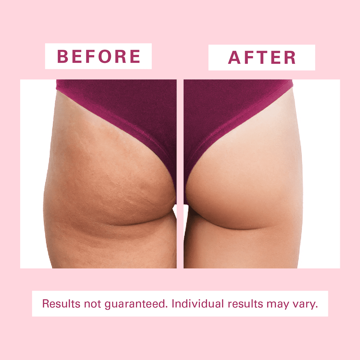 Before and after comparison of skin texture on thighs and glutes 