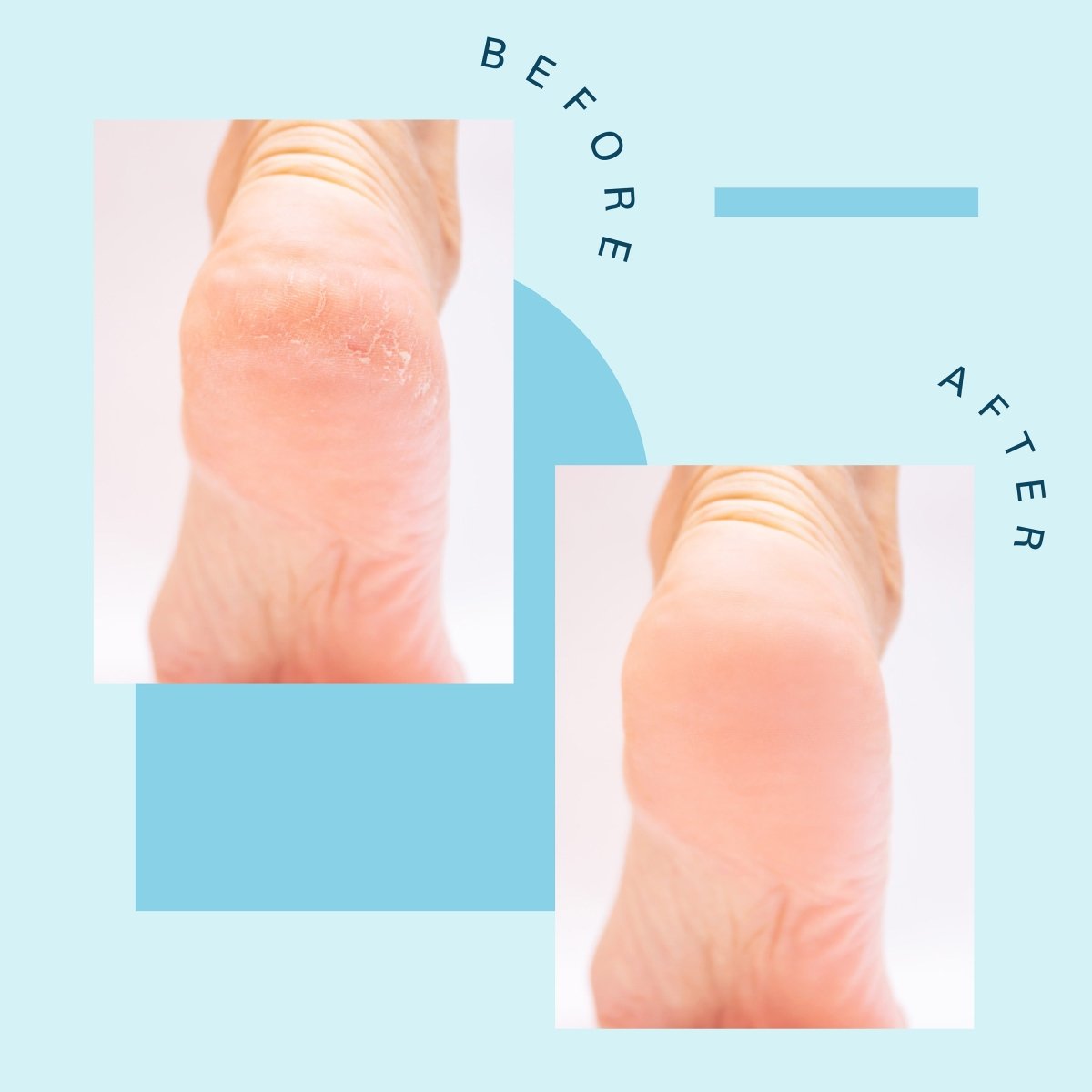 Before and after comparison of feet with rough, cracked heels made smoother.
